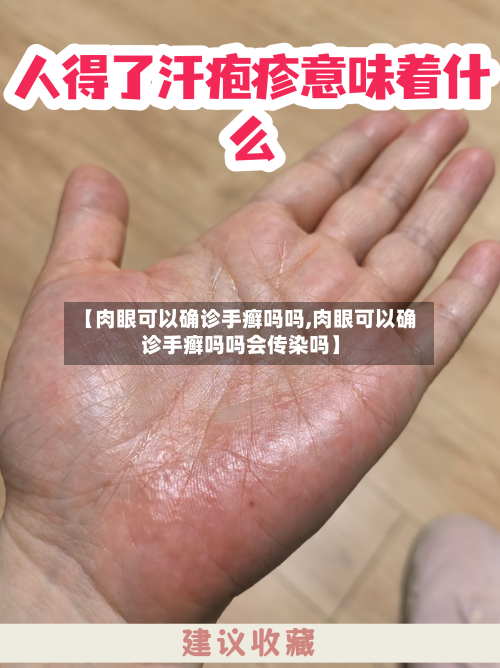 【肉眼可以确诊手癣吗吗,肉眼可以确诊手癣吗吗会传染吗】