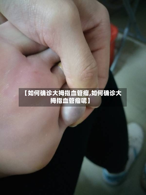 【如何确诊大拇指血管瘤,如何确诊大拇指血管瘤呢】-第1张图片