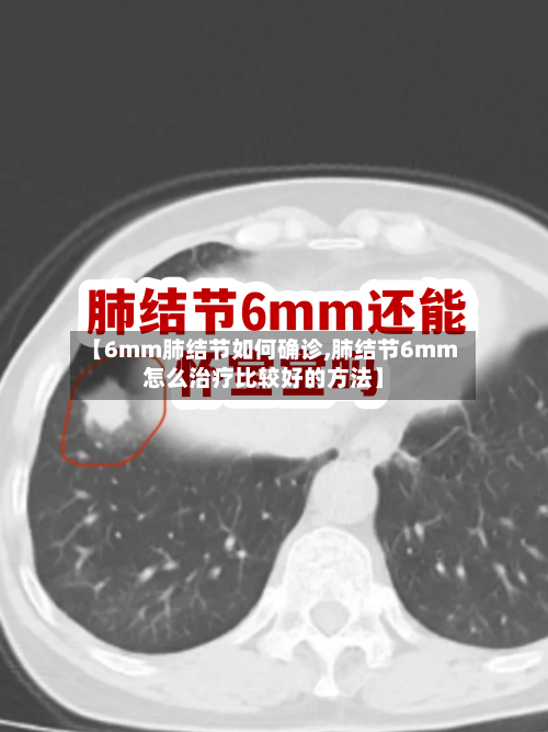 【6mm肺结节如何确诊,肺结节6mm怎么治疗比较好的方法】